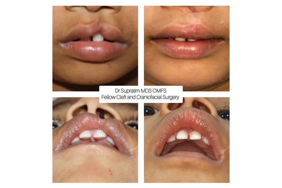 Cleft Lip and Palate Surgery