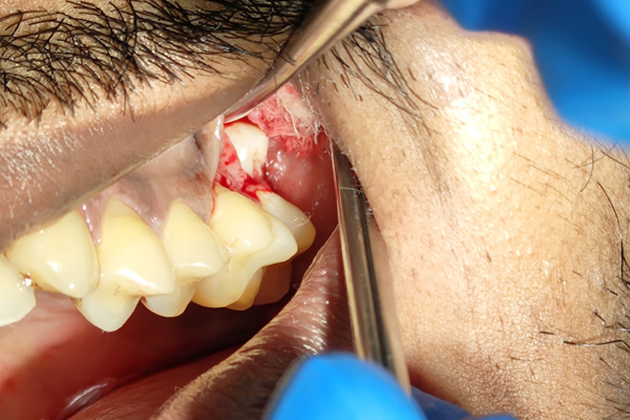 Tooth Extractions and Wisdom Tooth Extractions
