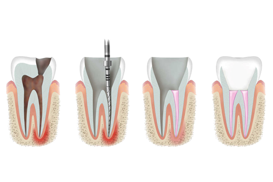 Root Canal Treatment