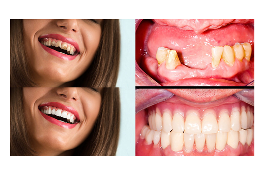 Full Mouth Rehabilitation